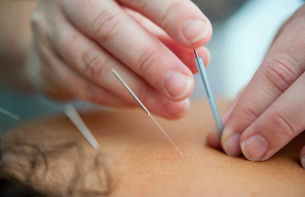 Acupuncture corps quelles sont les bienfaits ? 